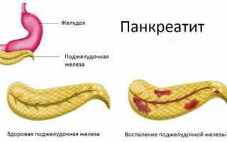 Может ли повышаться давление при панкреатите и как с этим бороться