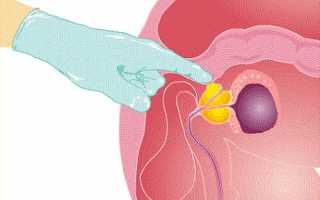 Виды прямого массажа простаты