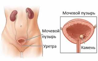 Чем обусловлено развитие женского уретрита