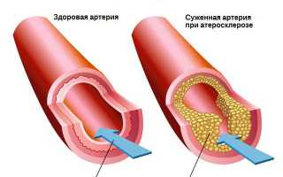 Лимон повышает или понижает давление и как сделать из него лекарство?