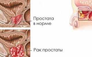 ТАУЗИ при простатите