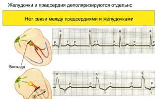 Нарушение плохой проводимости сердца или сердечная непроходимость