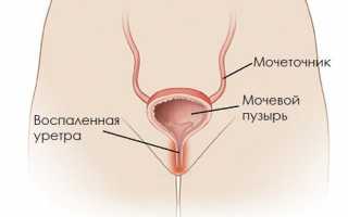 По каким симптомам можно распознать развицие цистита